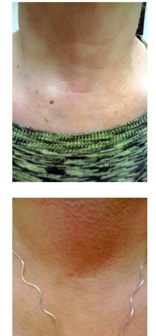 Parathyroidectomy after photos — healed neck incision following minimally invasive parathyroid surgery