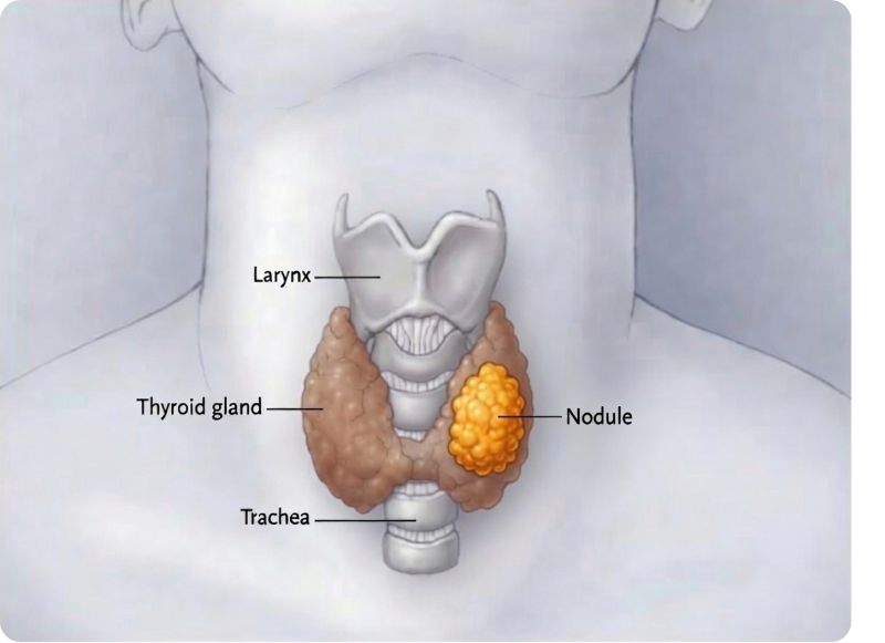 Illustration of a thyroid nodule on the thyroid gland