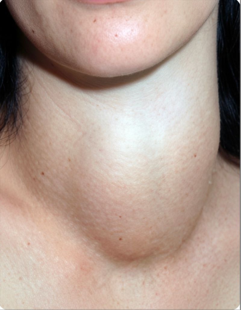 Visible thyroid nodule on the neck of a thyroid surgery patient