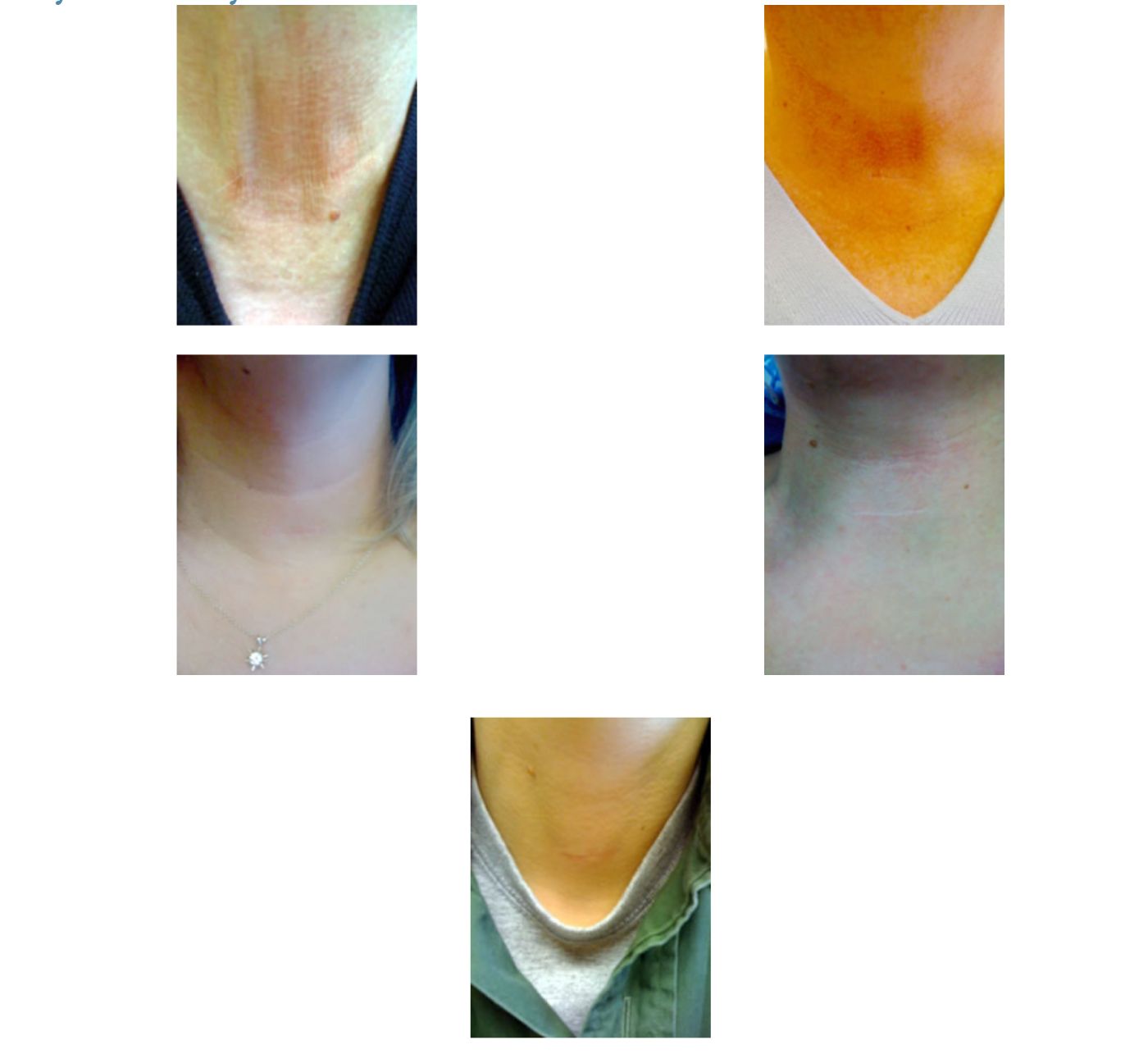 Thyroidectomy after photos — healed neck incisions following minimally invasive thyroid surgery